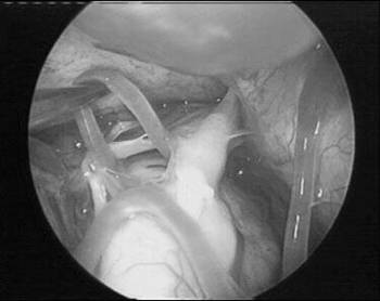 Fully Endoscopic Vascular Decompression of The Trigeminal Nerve